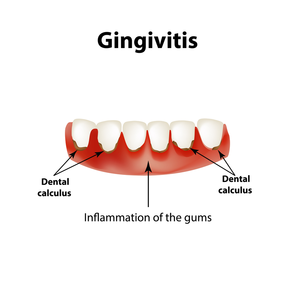 Gingivitis-reversible-stage-red-swollen-bleeding-gums-before-treatment-Kaizen-Dental-Sector-50-Noida